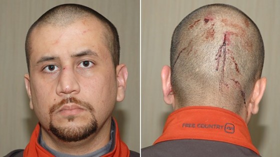 USA.george_zimmerman_injuries