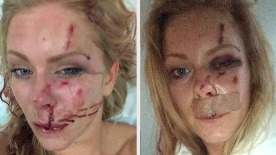 Nanna Skovmand overfaldet