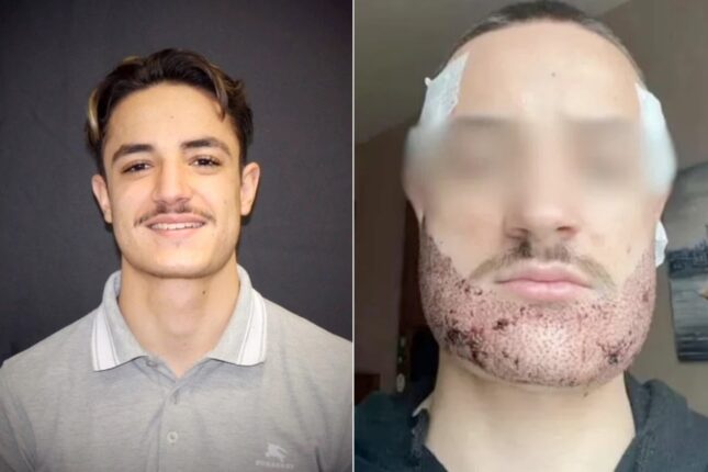 Fransk student fikk «pinnsvin&shy;aktig» skjegg efter transplantasjon av hår i Tyrkia. Begikk selvmord